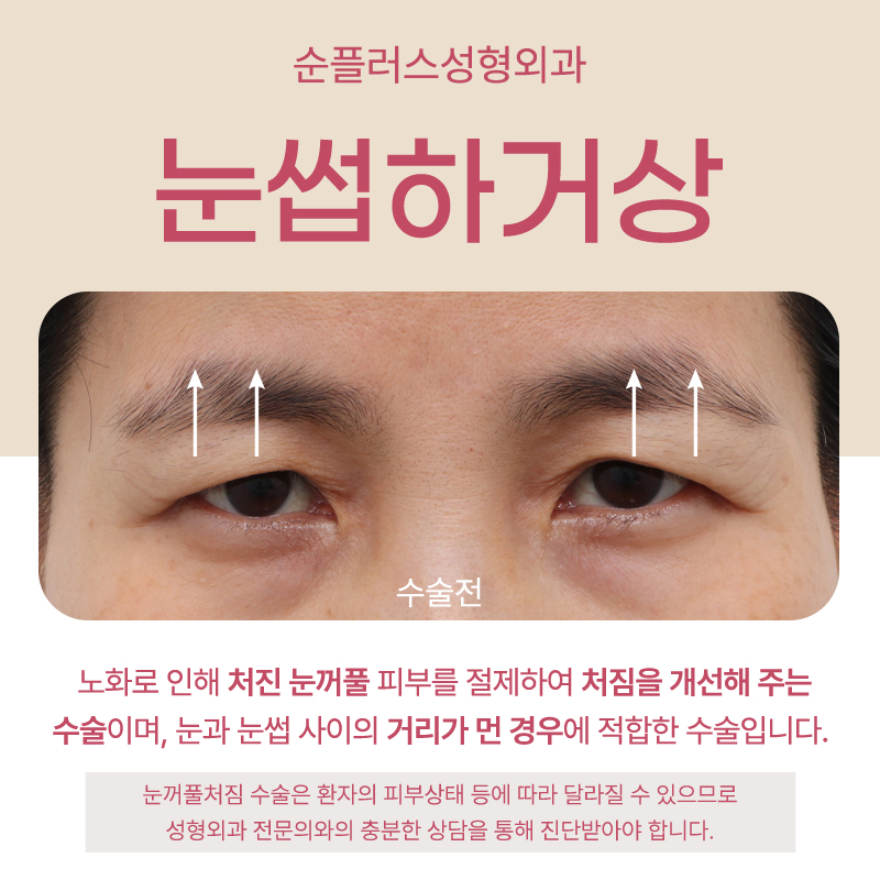 눈썹하거상 흉터 노출 줄이면서 눈은 또렷하게 관련 이미지 2