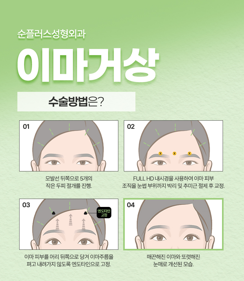 강남/신사 이마거상잘하는곳 선택이 많은 이유는 관련 이미지 3