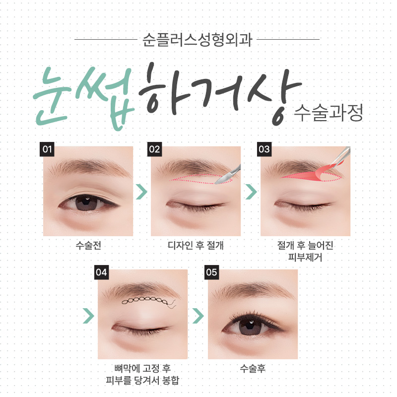 [눈썹거상수술] 눈과 눈썹 거리가 먼 경우, 눈꺼풀이 처졌을때 관련 이미지 4