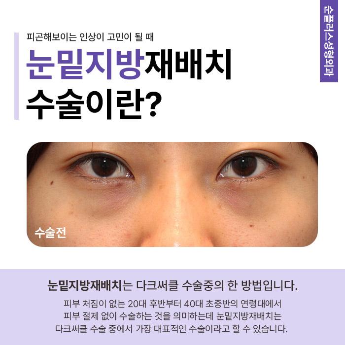 Improving Bumpy Under-Eye Contours Caused by Hollowing and Fat Bulging Through Under-Eye Fat Surgery image 2