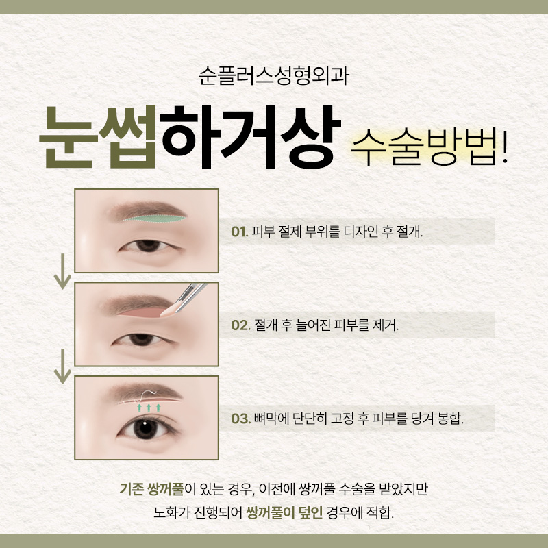 눈과 눈썹사이 거리가 멀고 처진눈꺼풀이 신경쓰인다면 [눈썹거상] 관련 이미지 3