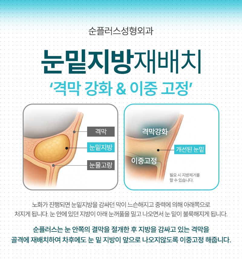 눈밑지방재배치 재수술 예방 위해 격막강화, 이중고정으로 관련 이미지 4
