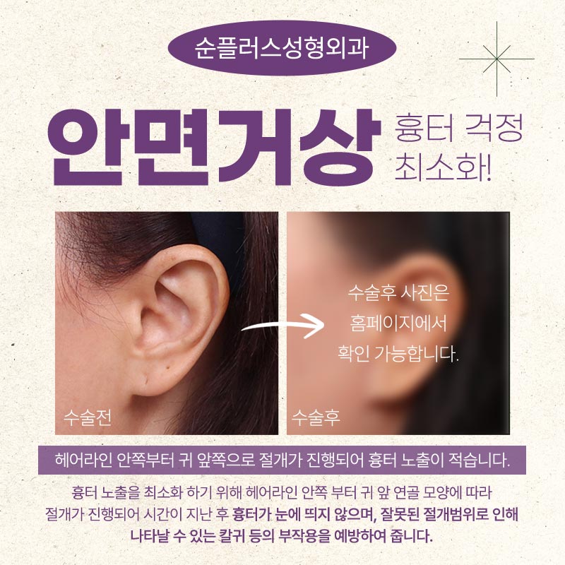 Facelift Effect: When Skin Elasticity Improves image 5