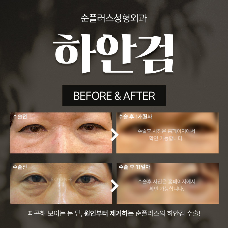 하안검수술잘하는곳 신사역에서 찾는다면 관련 이미지 5