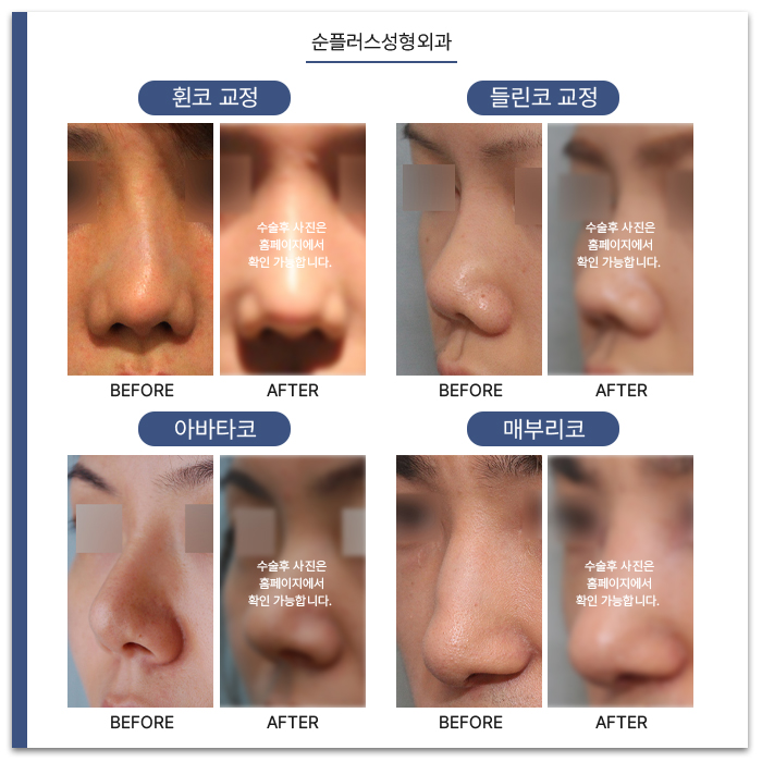 Before Choosing Revision Rhinoplasty image 4