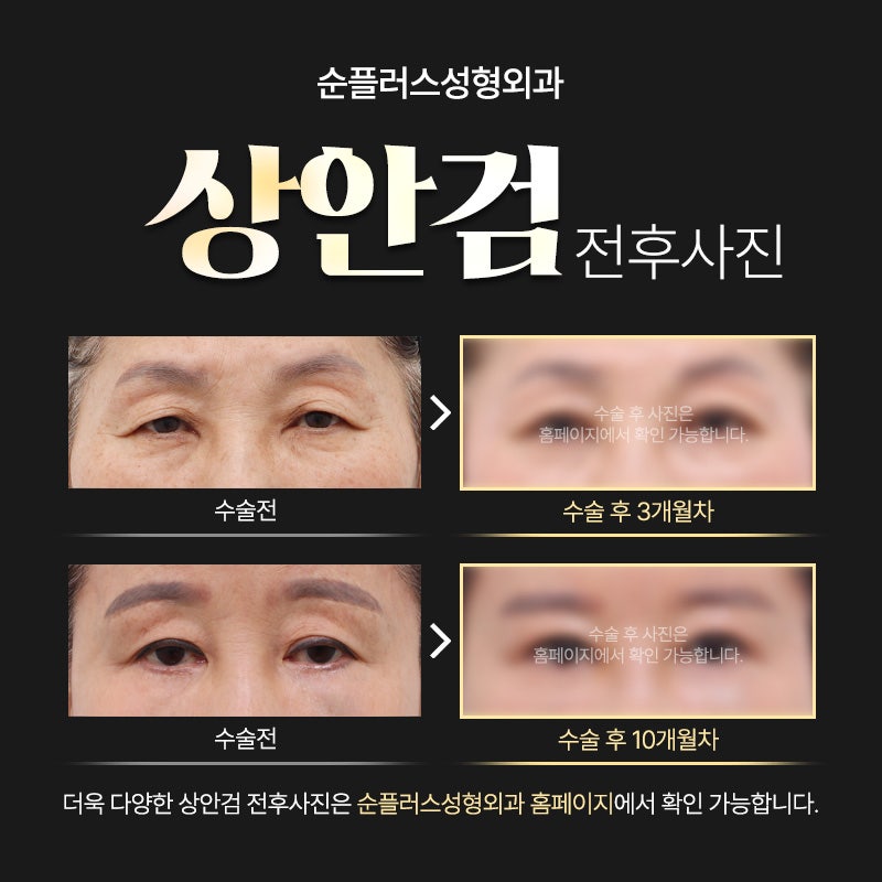 50대 60대쌍꺼풀, 중년눈성형은 처진눈꺼풀도 자연스럽게 개선해야 관련 이미지 5