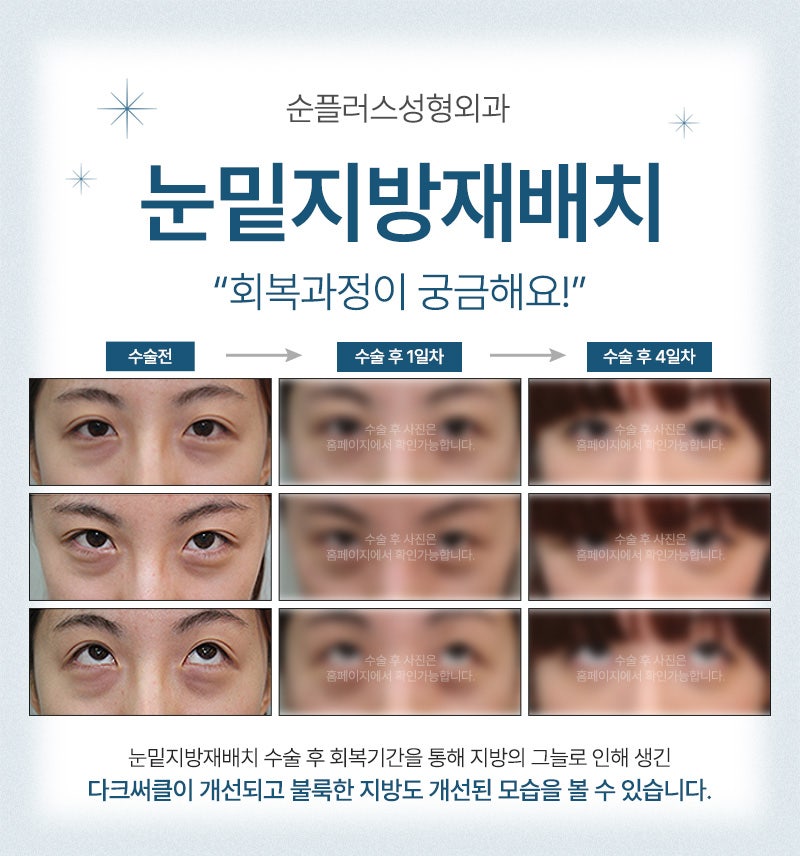 눈밑지방재배치 주의사항 체크와 회복기간 까지 관련 이미지 5
