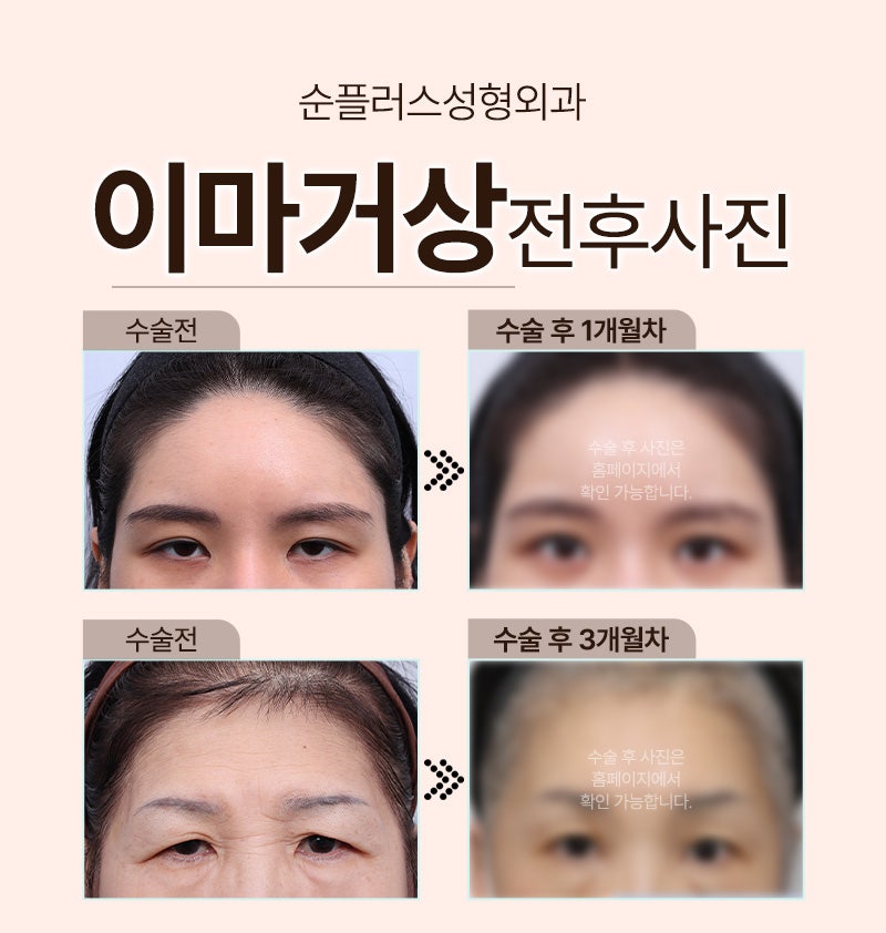 내시경이마거상 이마주름 미간주름 매끈하게 관련 이미지 6