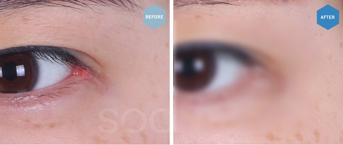 The approach to revision outer corner surgery varies depending on the cause image 7