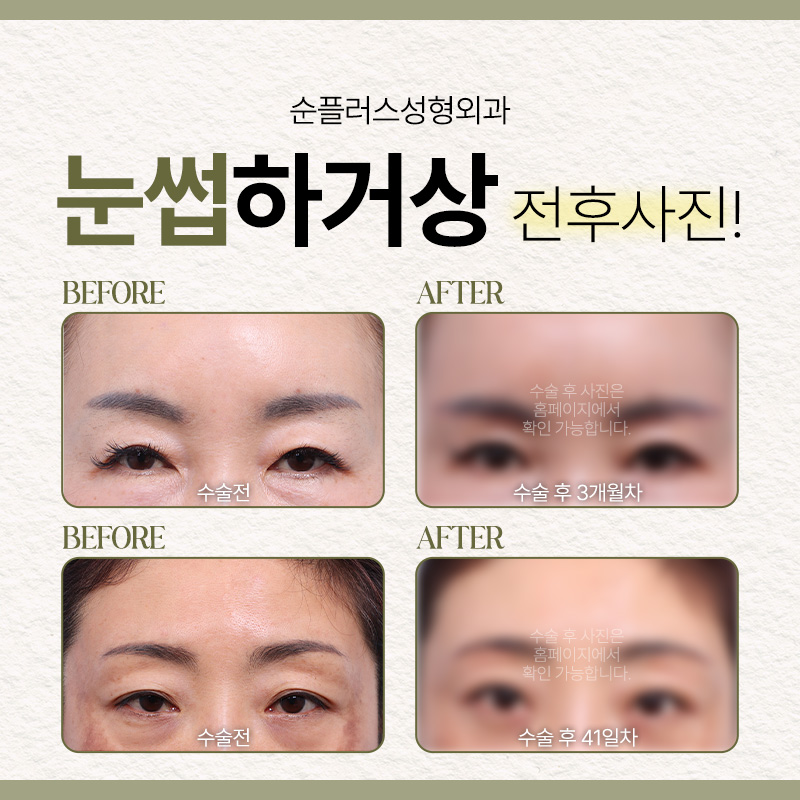 눈과 눈썹사이 거리가 멀고 처진눈꺼풀이 신경쓰인다면 [눈썹거상] 관련 이미지 6
