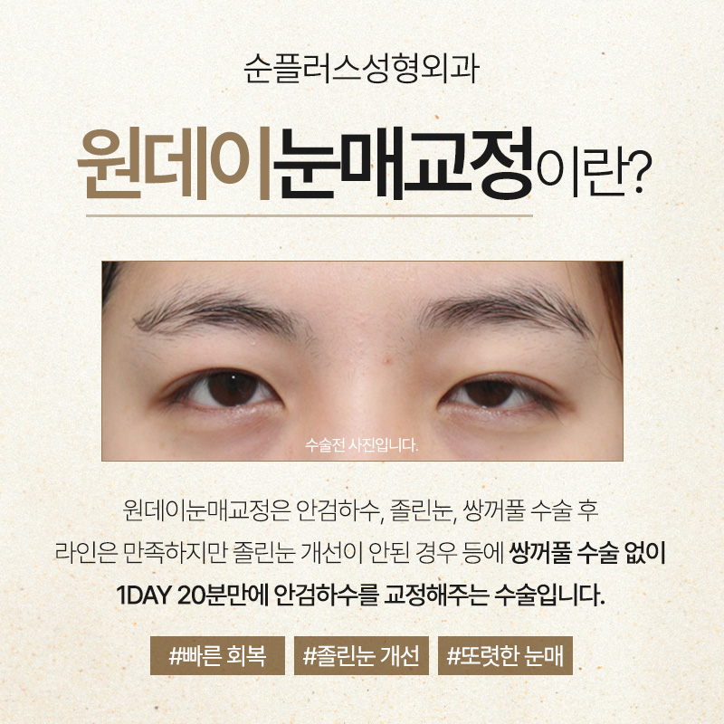 졸린눈 교정, 하루만에 개선된다면? [원데이눈매교정] 관련 이미지 2