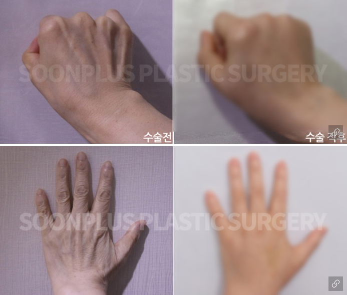 동안의 포인트는 손에서 나온다? [손등지방이식] 관련 이미지 6