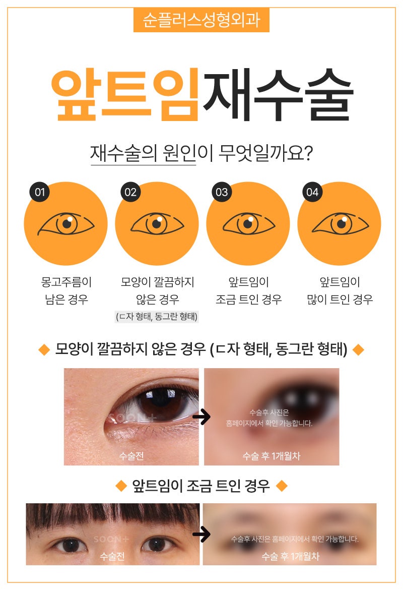 앞트임재수술 복원으로 눈앞머리 자연스럽게 관련 이미지 3