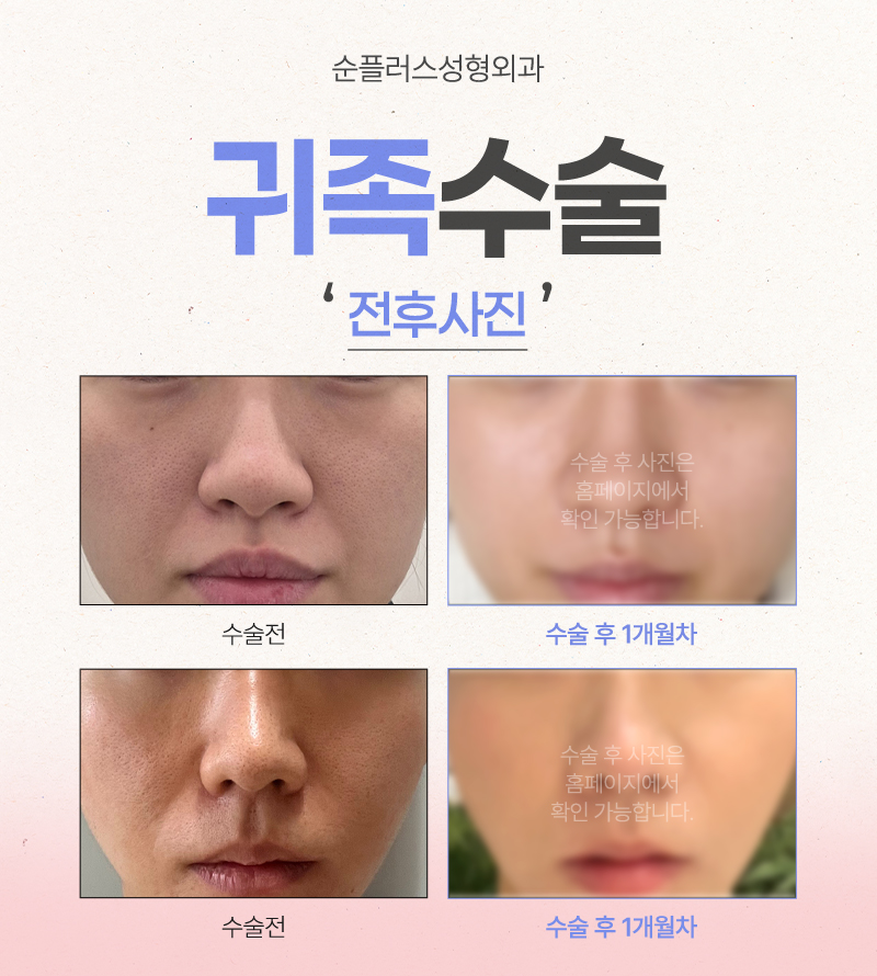 A Choice to Improve the 3D Appearance of Nasolabial Folds: How Much Does Noble Surgery Cost? image 6
