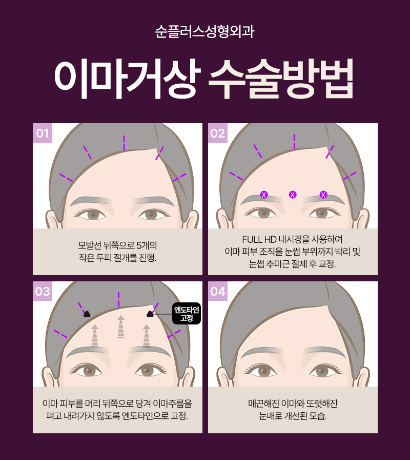 Before and after a forehead lift: what differences in effect might there be? image 5