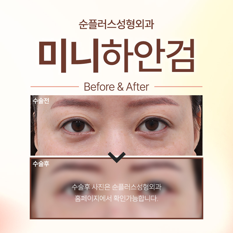 Mini Lower Blepharoplasty Depending on the Degree of Under-Eye Sagging image 2