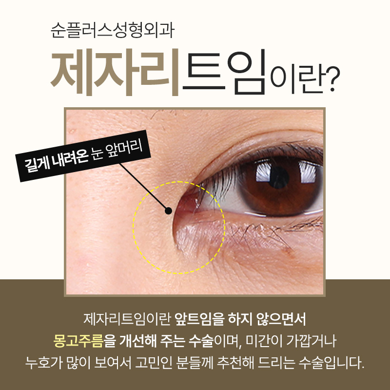 트임 부작용 개선과 몽고주름 제거로 눈매를 부드럽게 [앞트임-제자리트임] 관련 이미지 2
