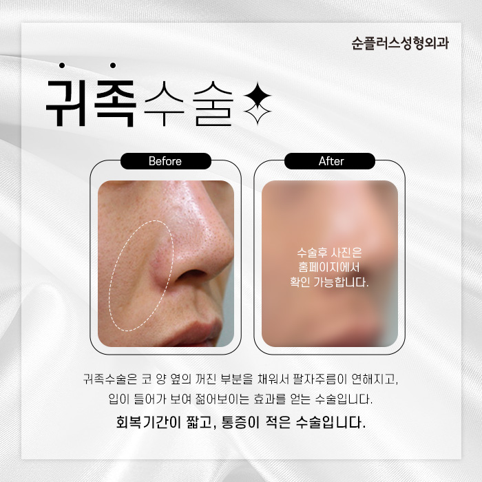 젊은층부터 중년까지 팔자고민엔 귀족수술 관련 이미지 2