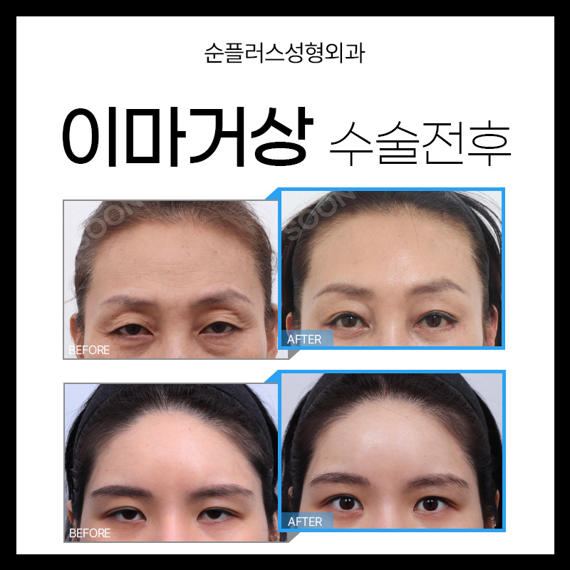 내시경이마거상 어떻게 진행되는지 관련 이미지 6
