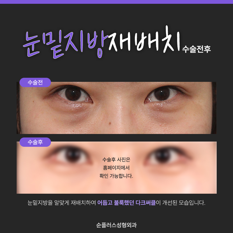 Lower Eyelid Fat Surgery Cost: If Bumpy Under-Eyes Are a Concern image 6