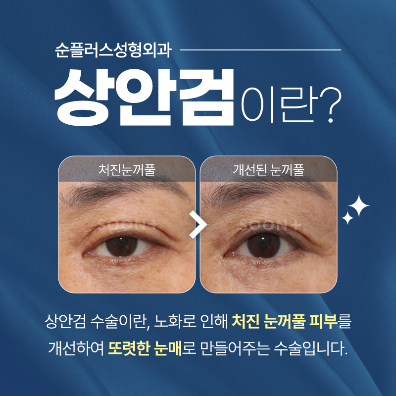 Blepharoptosis Surgery: Considering Both Aesthetics and Function image 2