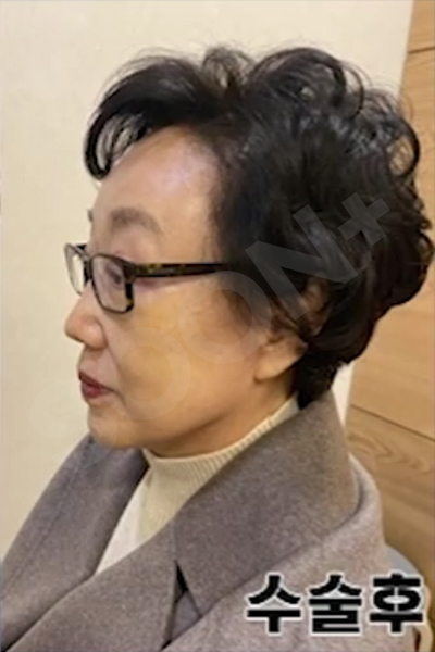 The Degree and Direction of Tension at a Clinic That Specializes in Facelifts image 7
