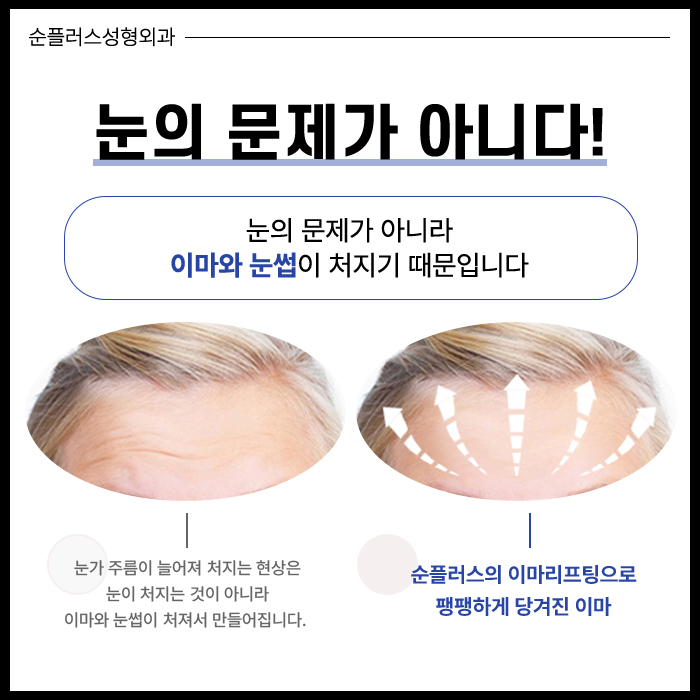 이마리프팅 정교함의 차이로 관련 이미지 3