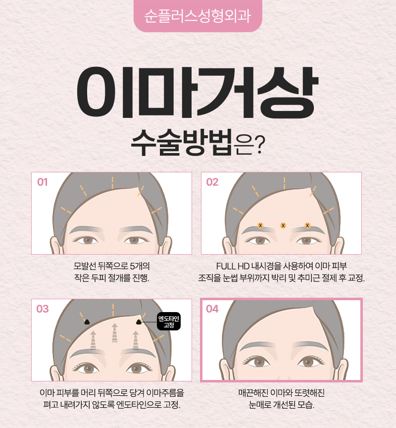 카리나 눈매 처럼 부담스럽지 않은 시원한 눈매효과를? 이마거상 관련 이미지 4