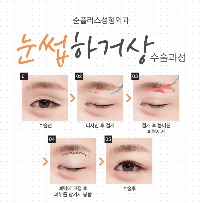 눈꺼풀처짐수술 중년눈꺼풀이 처졌다면 관련 이미지 6