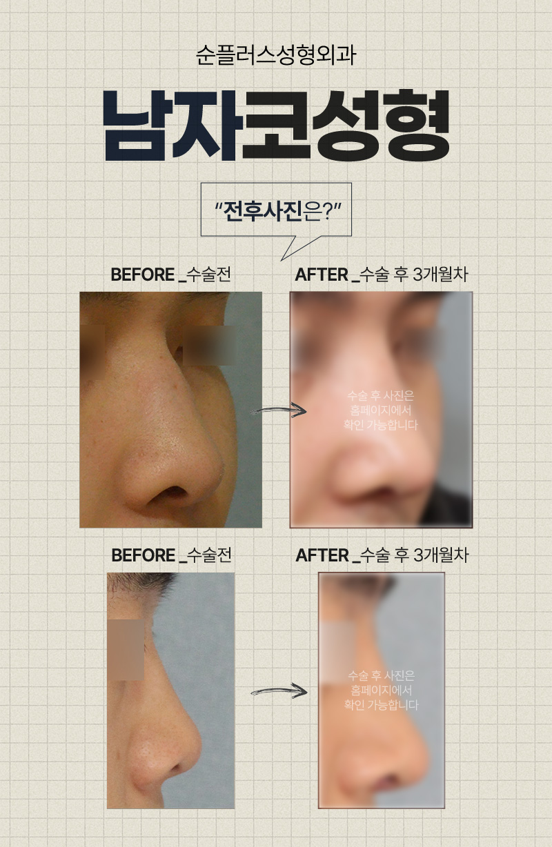 남자코성형외과 뚜렷한 티존과 직선콧대로 입체감 살리고 관련 이미지 4