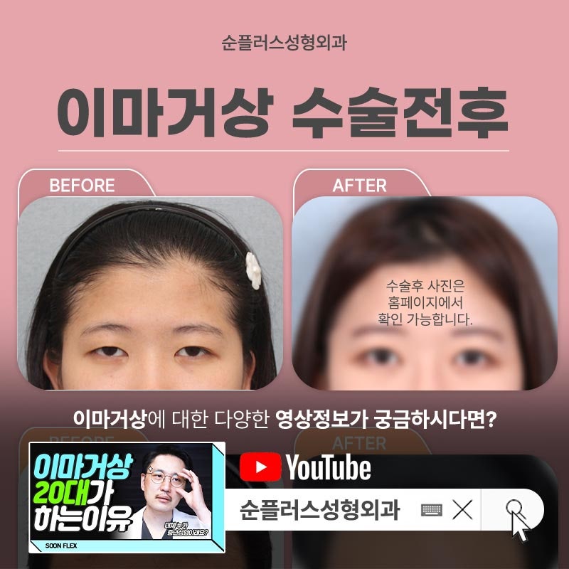 Forehead Wrinkle Removal Surgery, Including Between the Eyebrows and the Bridge of the Nose image 7