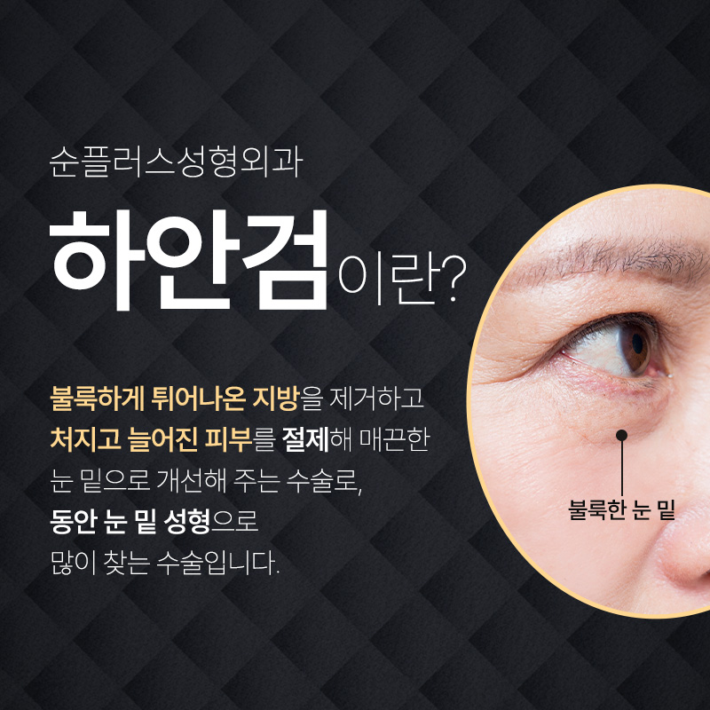 하안검재수술도 원인에 맞는 플랜으로 관련 이미지 2