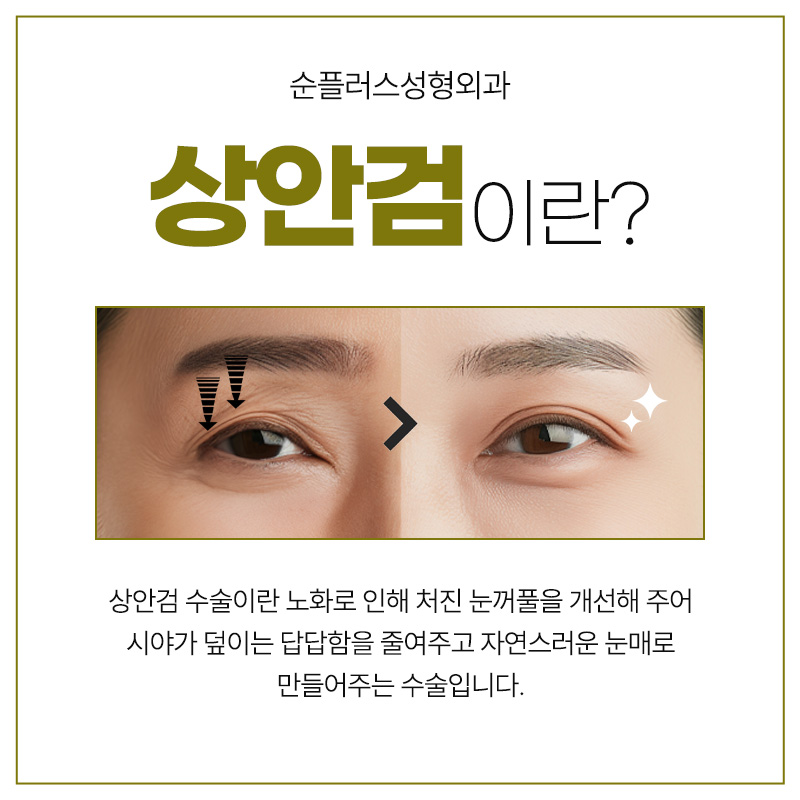 How Long Is the Recovery Period, Including Upper Blepharoplasty Swelling? image 2