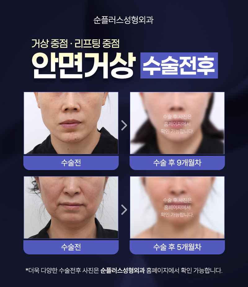 서울 안면거상 추천 자연스럽게 처짐을 끌어올려 관련 이미지 5