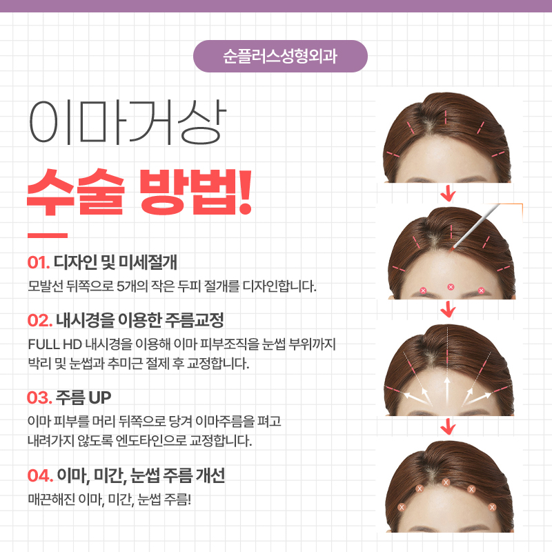 내시경이마거상 추천케이스가 따로 있나요 관련 이미지 4