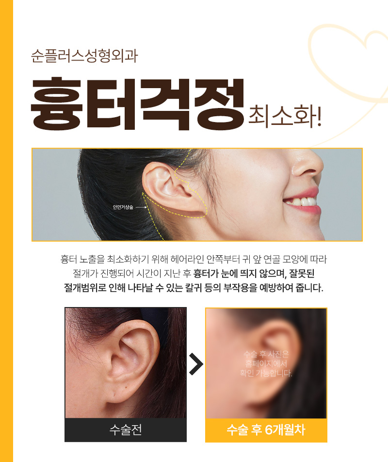 A Place Known for Good Facelift Surgery While Reducing Scarring image 6