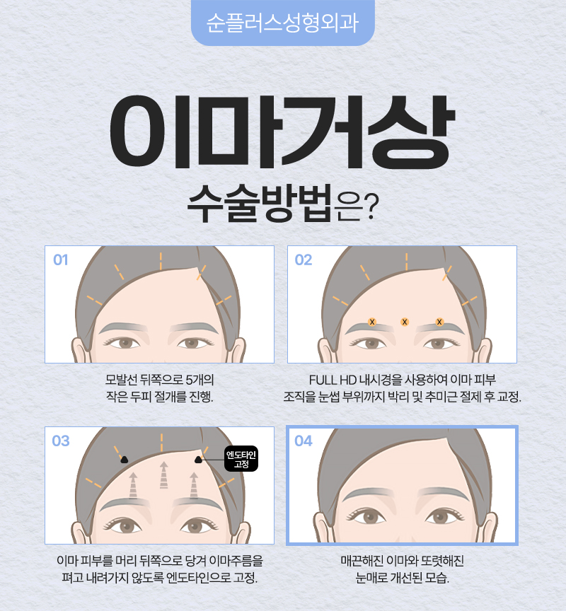 처진 이마와 눈썹, 이마리프팅(이마거상)으로 어떻게 달라질까 관련 이미지 5