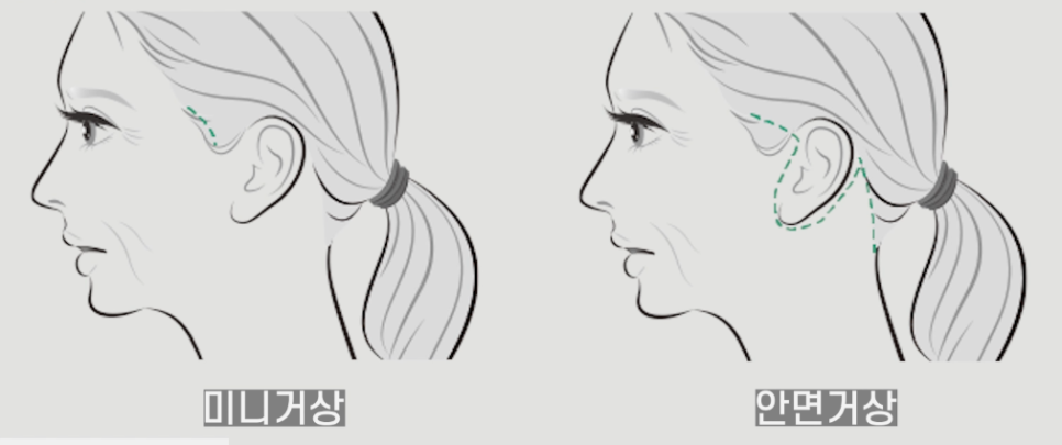 윤곽수술 후 리프팅 혹은 살처짐 개선 리프팅 방법은 관련 이미지 4