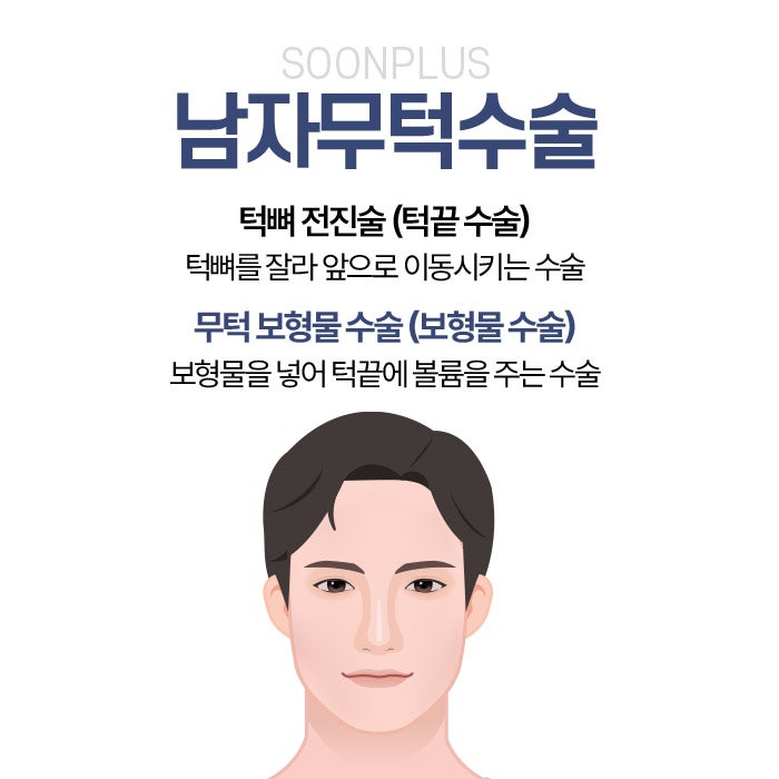 Male Chin-Deficiency Surgery: Even Just the Chin Tip Can Make a Difference image 3
