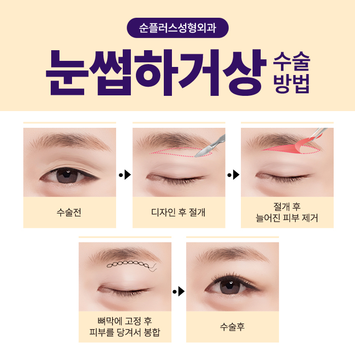 눈꺼풀처짐수술, 눈썹하거상 케이스로는 관련 이미지 3
