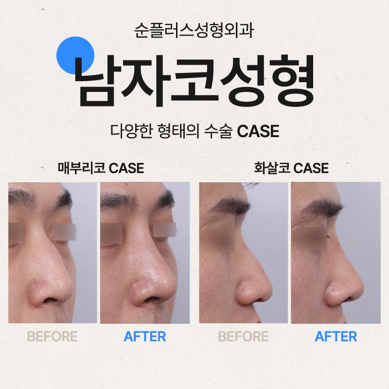 남자코성형잘하는곳 케이스별로 맞춘 관련 이미지 6