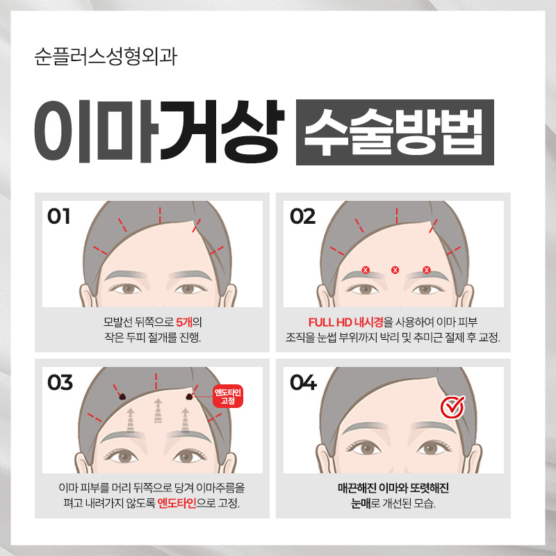 이마거상술효과 처진 이마와 눈매 개선을 동시에 리프팅 관련 이미지 5
