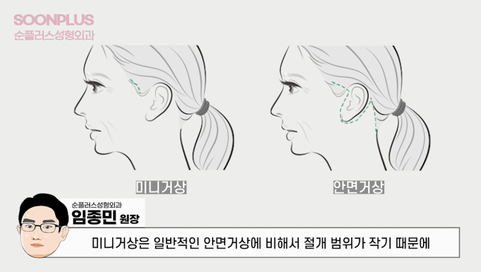 안면윤곽 후 (볼/살)처짐 어떻게 해야 개선될까 관련 이미지 5