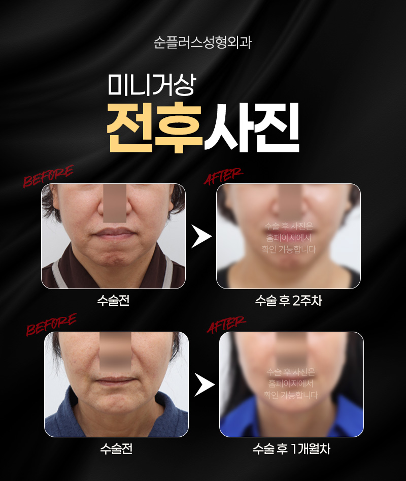 강남/신사 미니거상, 거상중점병원 맞춤 리프팅 설계 관련 이미지 5