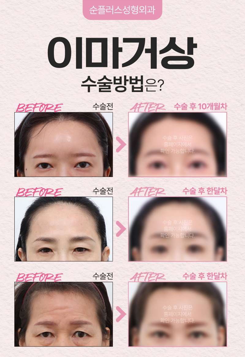 카리나 눈매 처럼 부담스럽지 않은 시원한 눈매효과를? 이마거상 관련 이미지 5