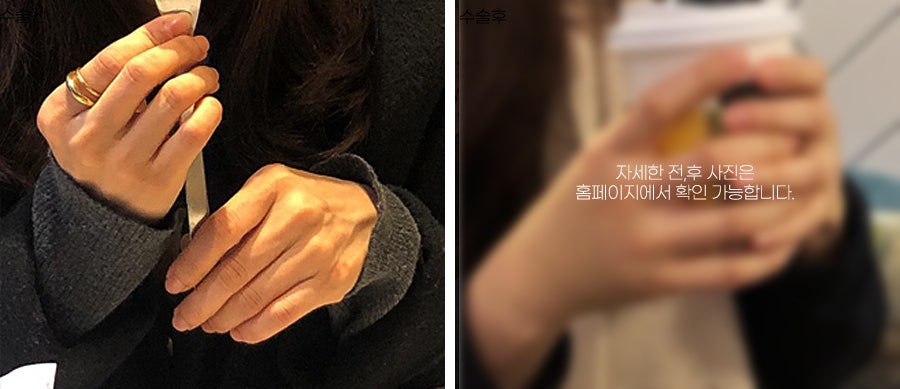 A lively effect for dry, wrinkled backs of the hands with fat grafting image 7
