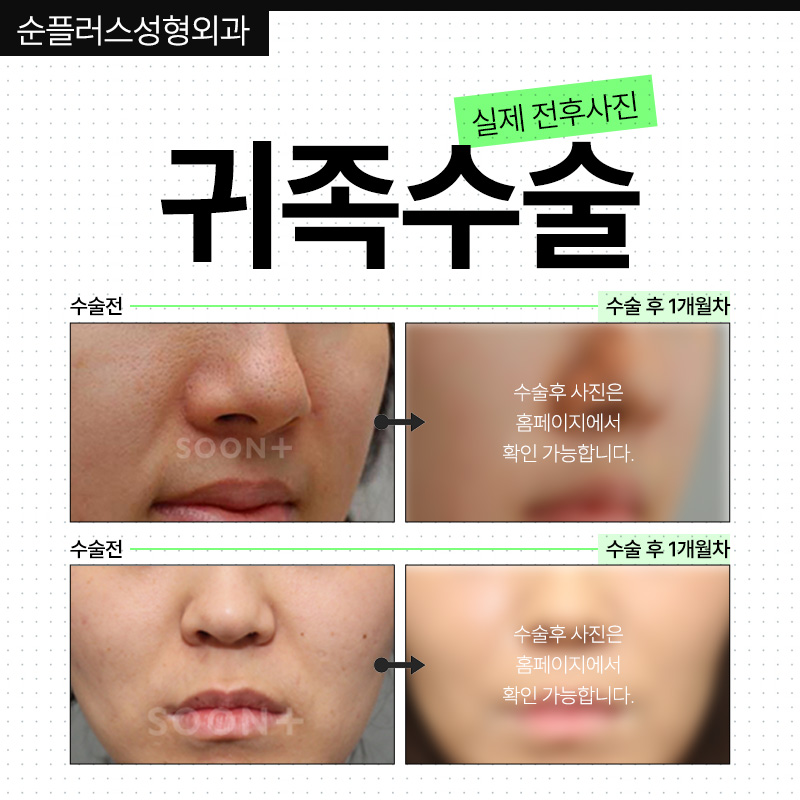 움푹한 코옆꺼짐으로 팔자주름 부각이 신경쓰인다면 맞춤보형물 귀족수술 통해 관련 이미지 5
