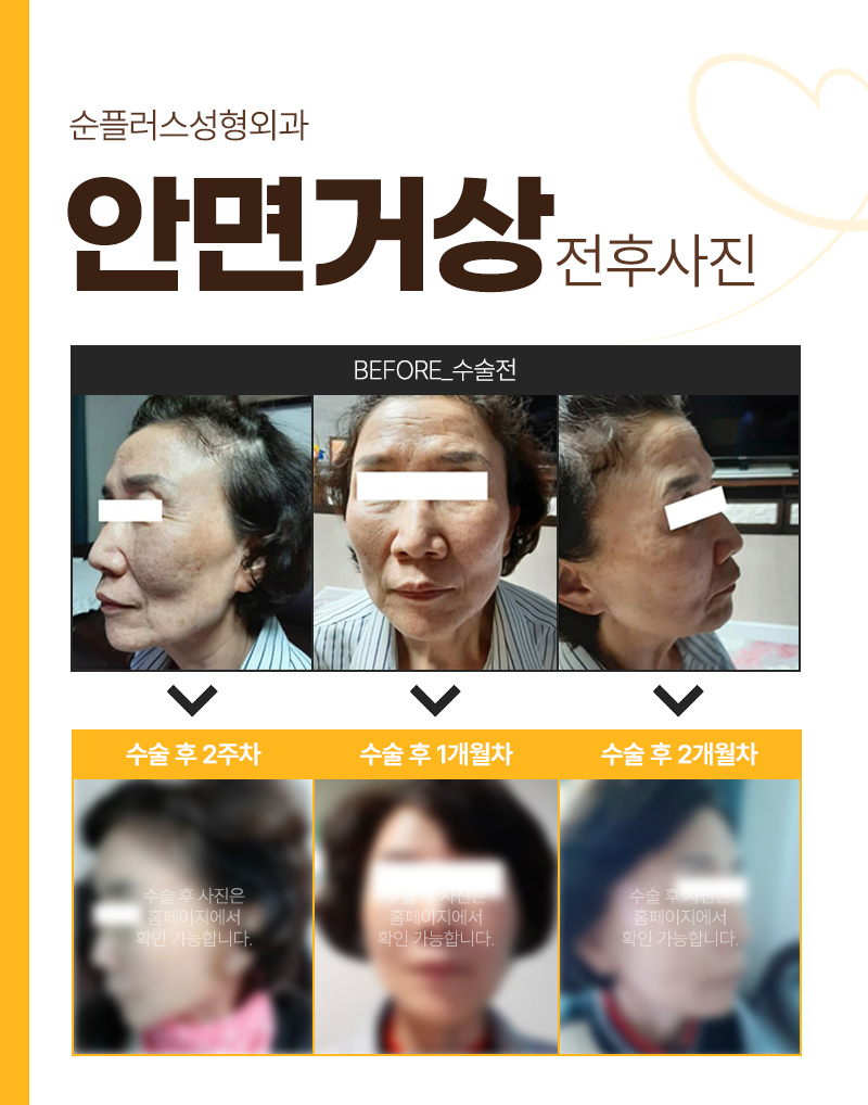 A Place Known for Good Facelift Surgery While Reducing Scarring image 7