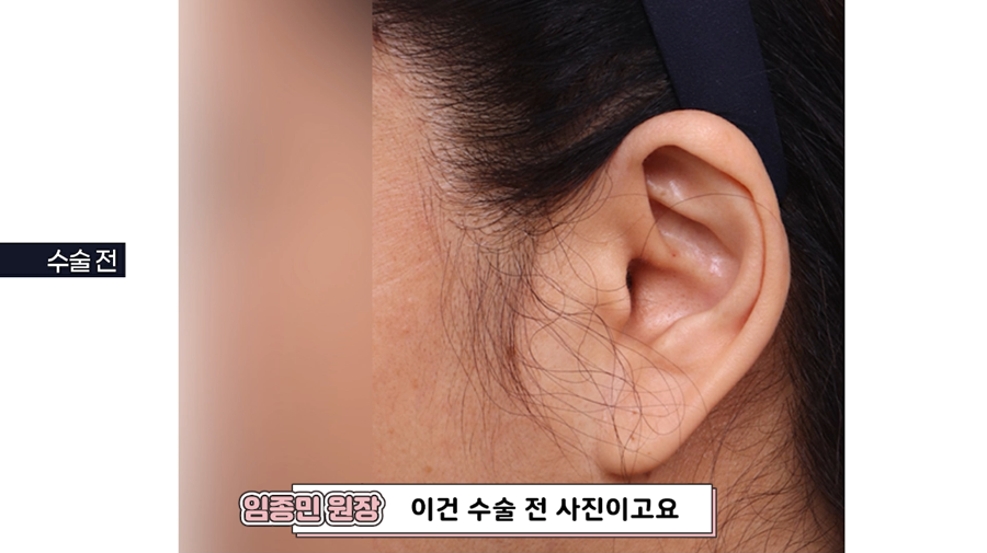 안면거상회복과정, 흉터 아무는 시기 관련 이미지 6
