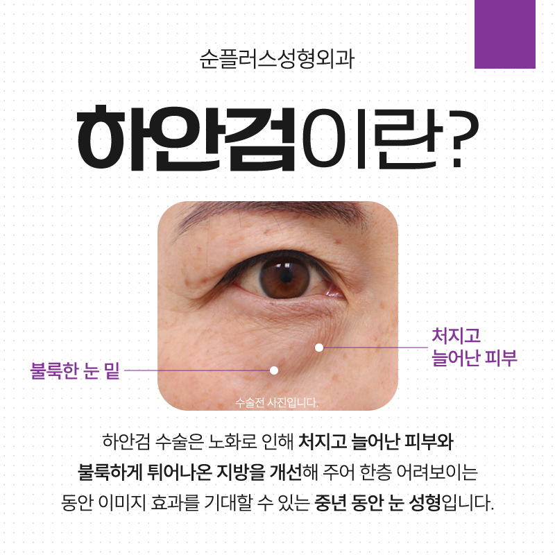 중년의 두툼한 눈밑 변화를 위한 하안검성형. 관련 이미지 2